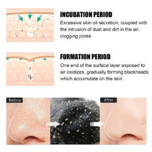 Remove Blackhead Nose Patch